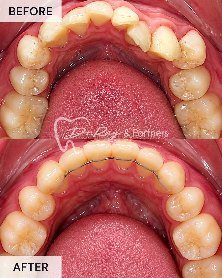 Before and after braces, lower teeth from above, crowding straightened at Dr Ray & Partners Dental