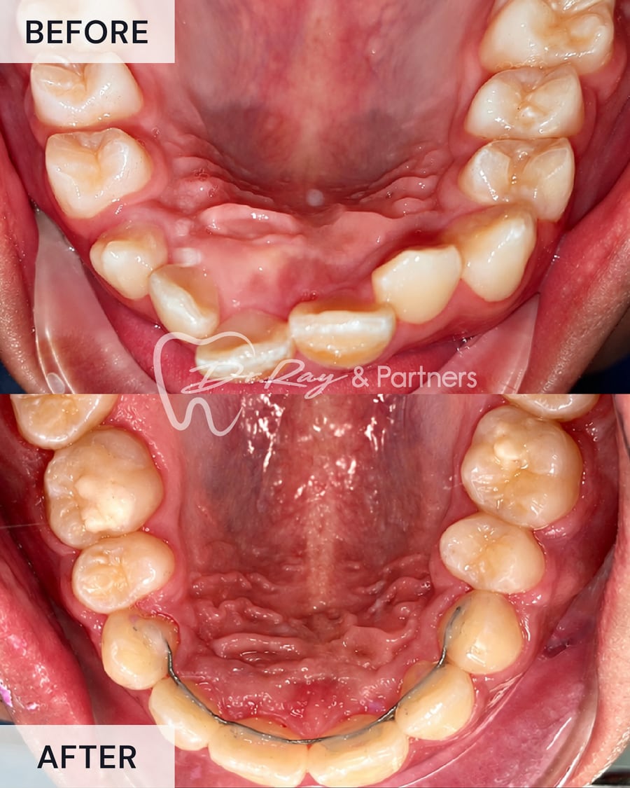 Before and after braces, upper teeth from above, crowding straightened at Dr Ray & Partners Dental