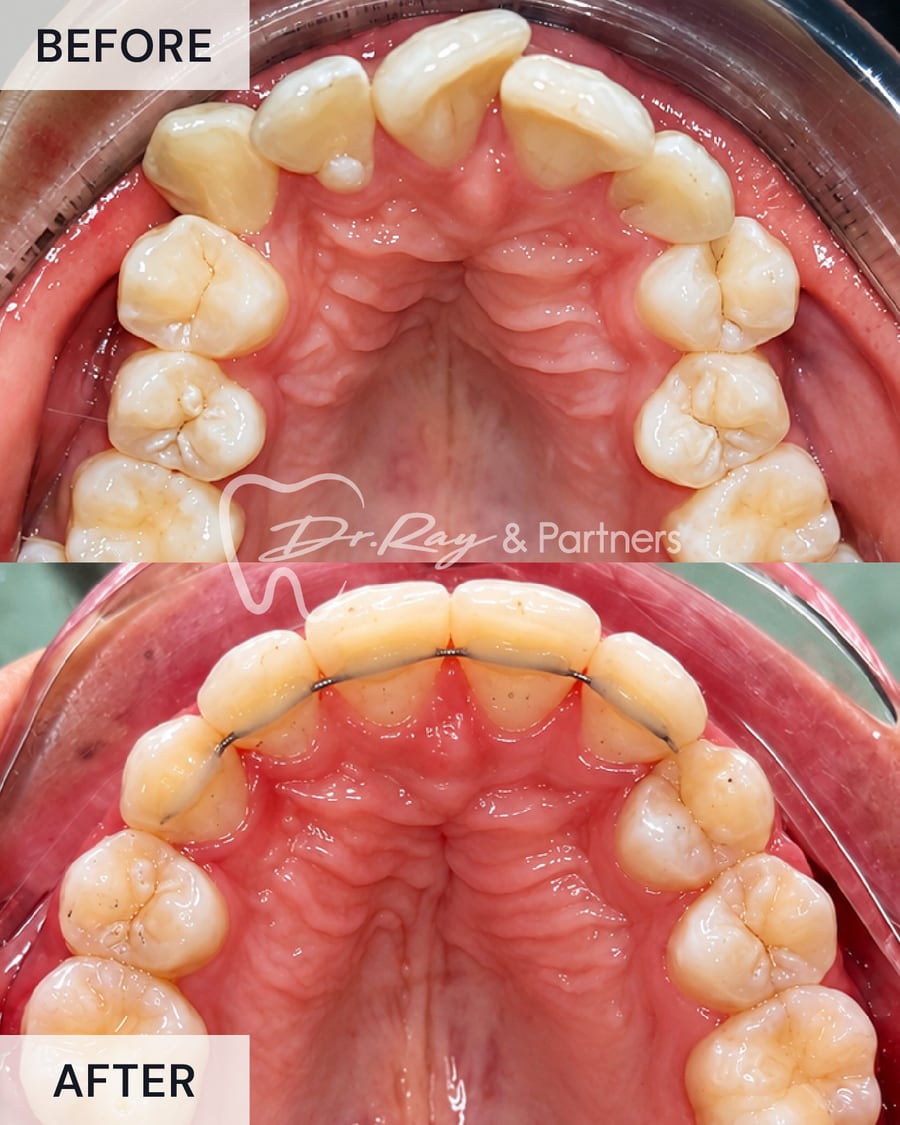 Before and after braces, upper teeth from above, arch aligned at Dr Ray & Partners Dental