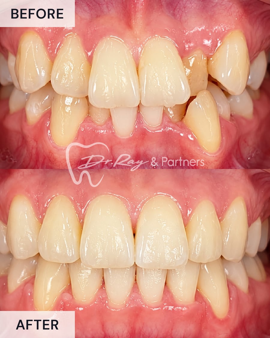 Before and after braces, front view, crooked teeth straightened at Dr Ray & Partners Dental