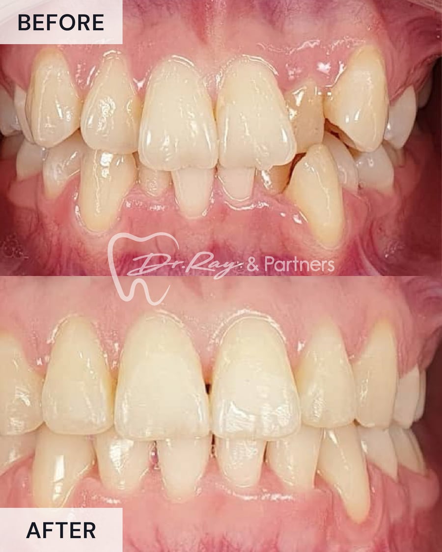 Before and after braces, front view, crooked teeth straightened at Dr Ray & Partners Dental
