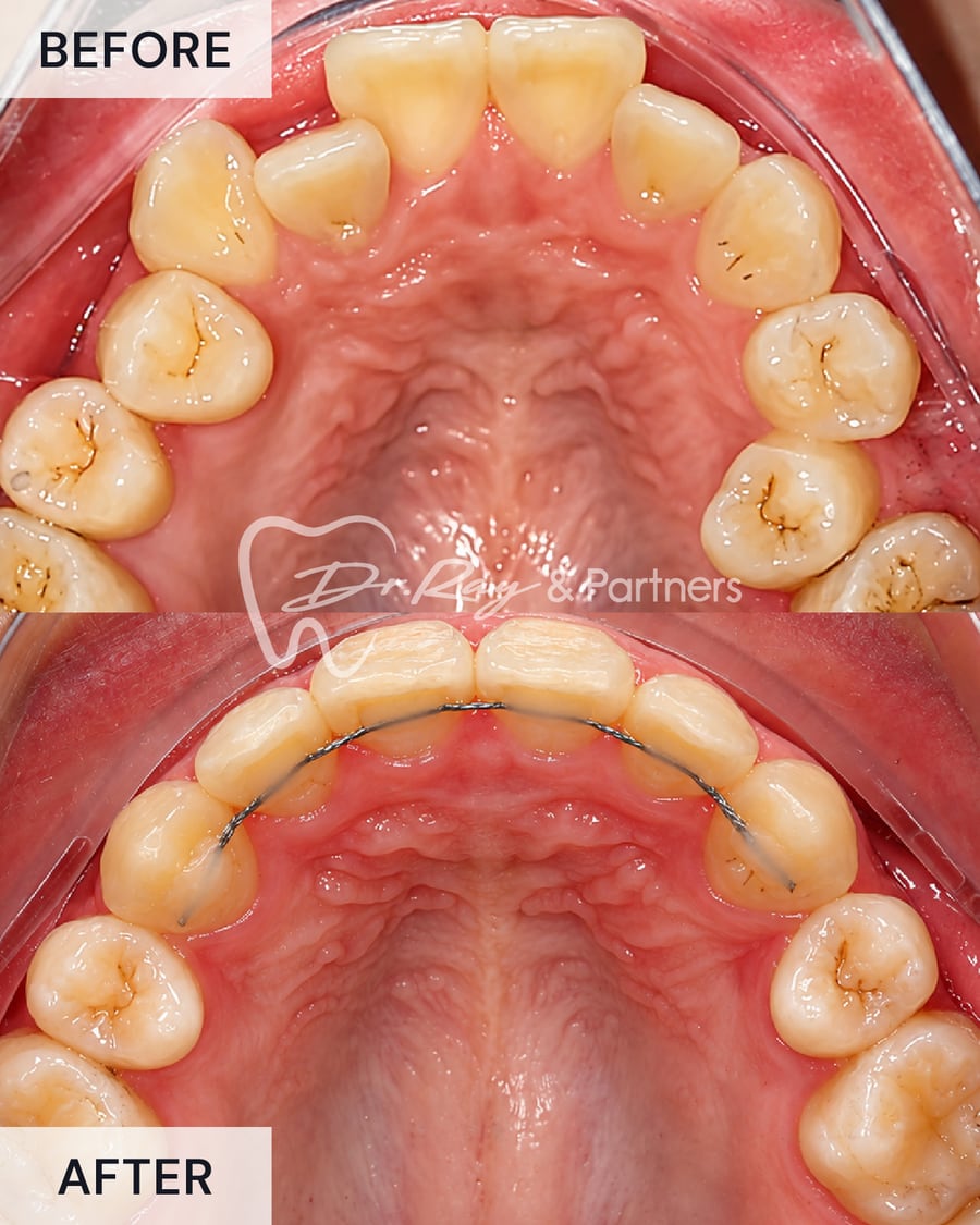 Before and after braces, upper teeth from above, front teeth aligned at Dr Ray & Partners Dental