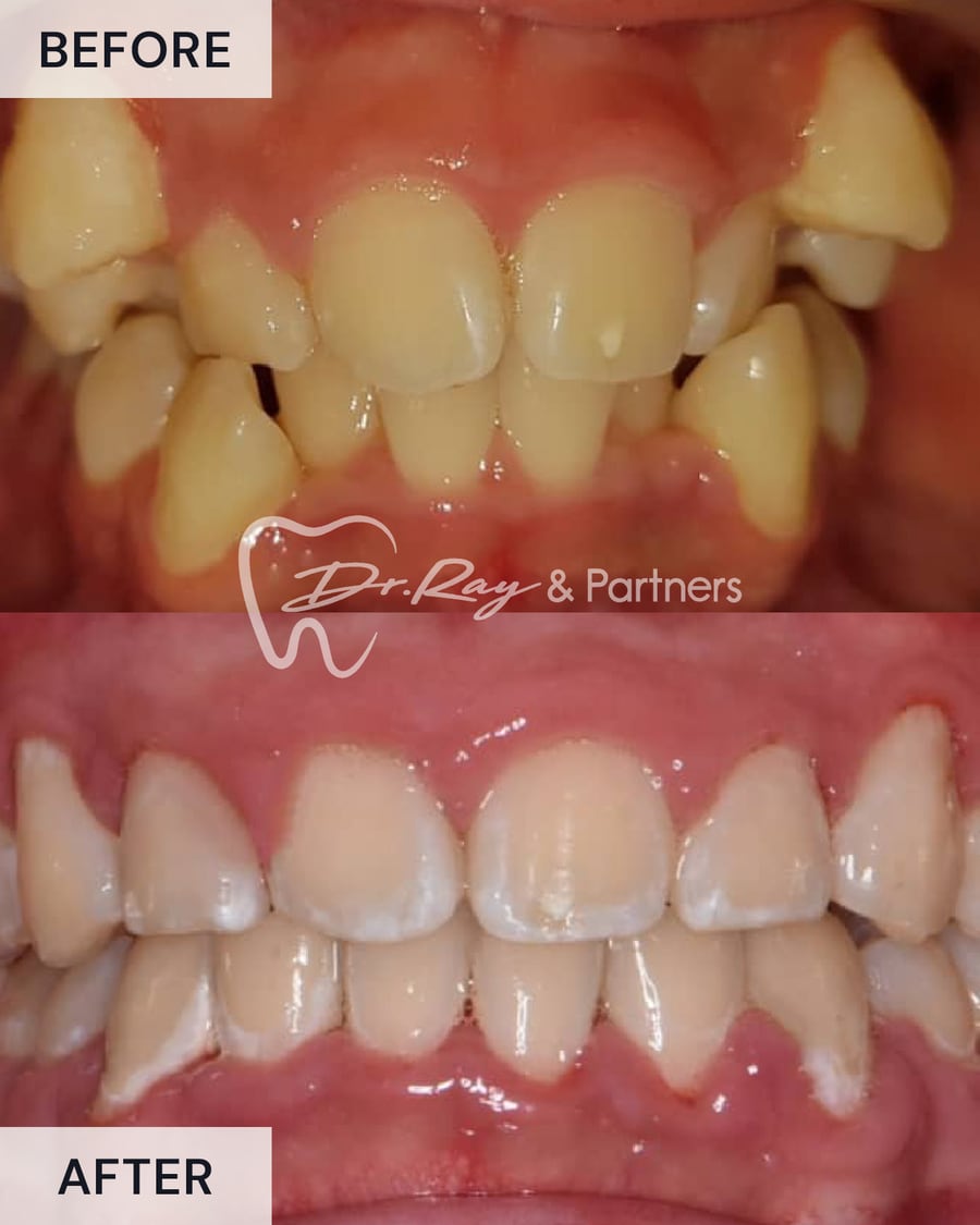Before and after braces, front view, crowded teeth straightened at Dr Ray & Partners Dental
