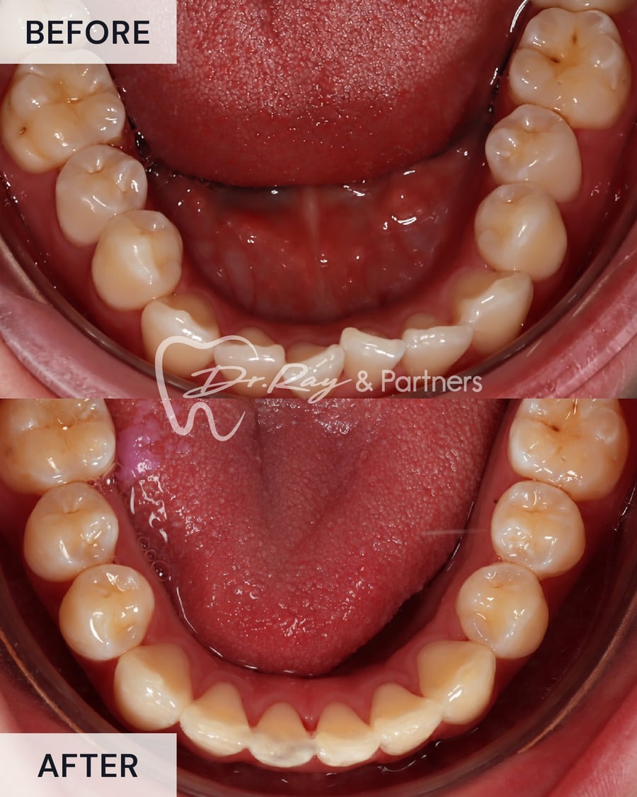 Before and after braces, lower teeth from above, crowding straightened at Dr Ray & Partners Dental