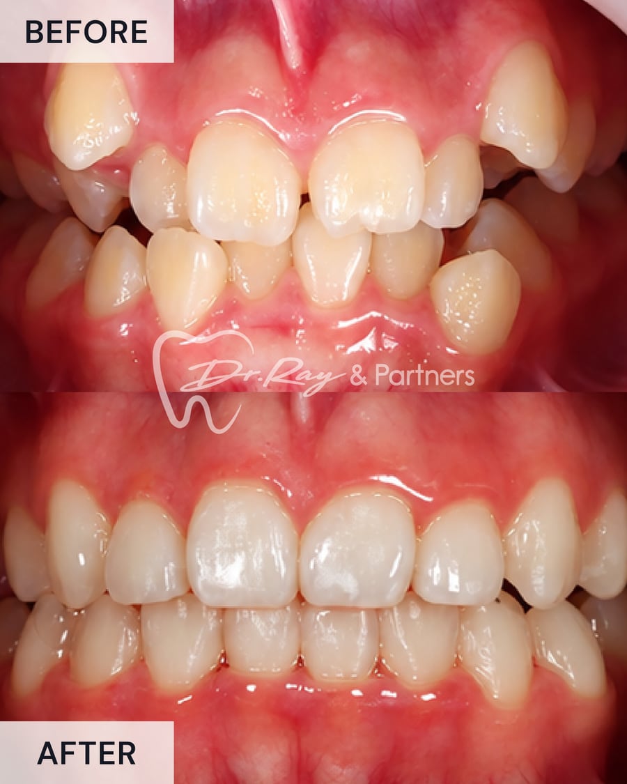 Before and after braces, front view, uneven teeth straightened at Dr Ray & Partners Dental
