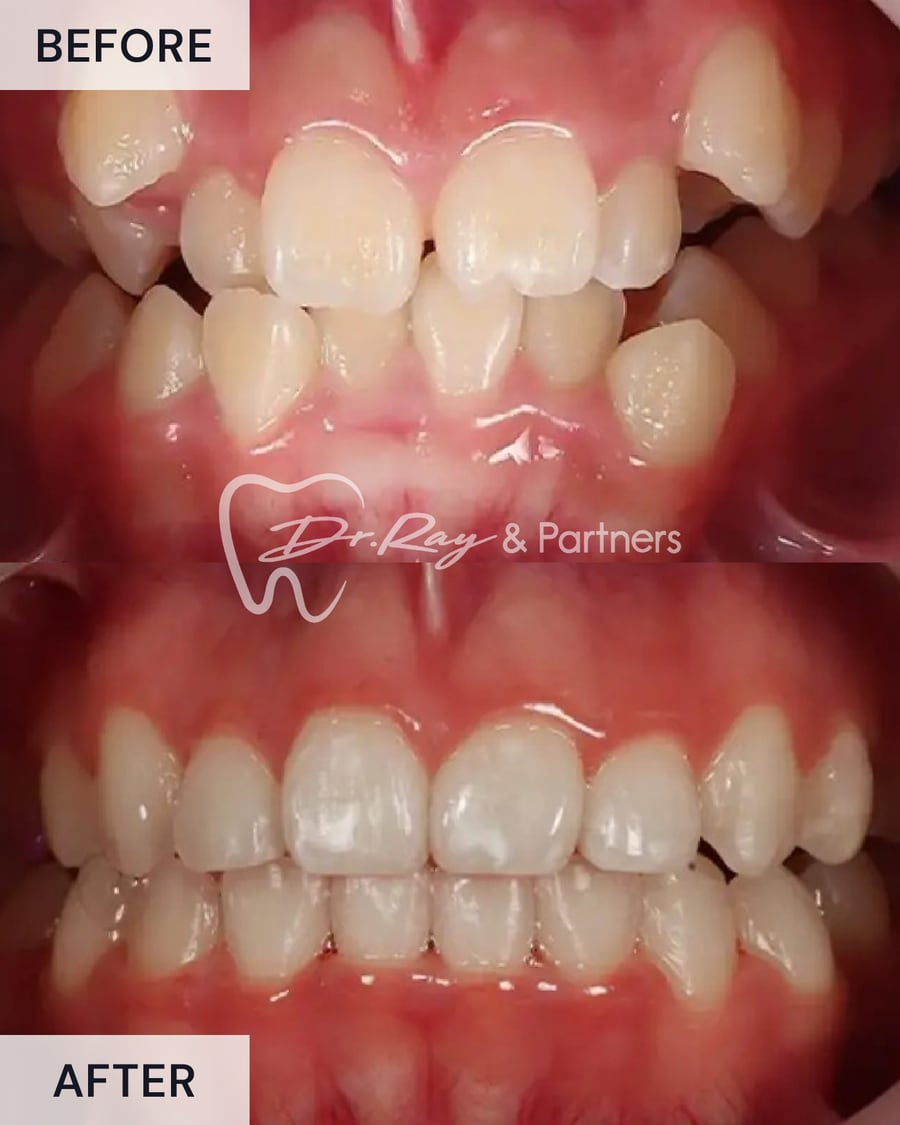 Before and after braces, front view, uneven teeth straightened at Dr Ray & Partners Dental