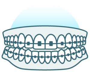 Illustration of teeth with braces brackets and a wire