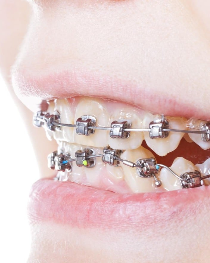 Braces