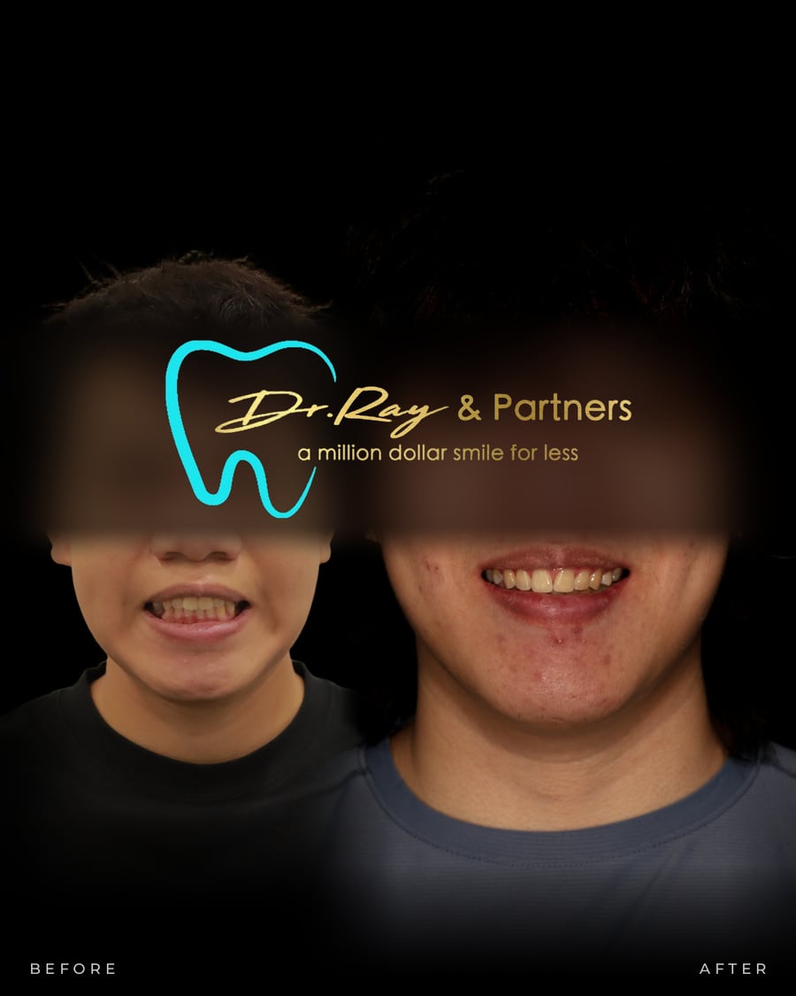 Braces patient smiling before and after treatment at Dr Ray & Partners Dental, eyes covered for privacy