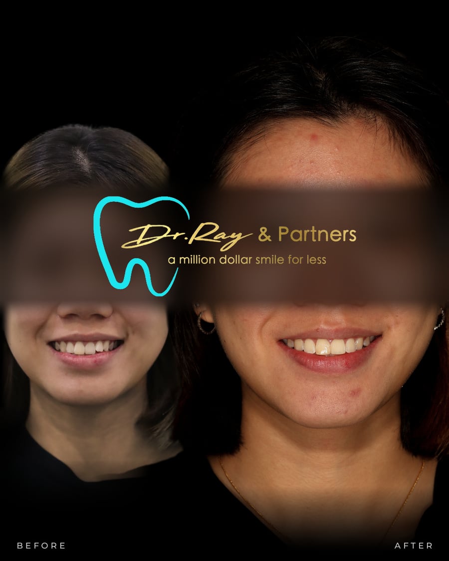 Braces patient smiling before and after treatment at Dr Ray & Partners Dental, eyes covered for privacy