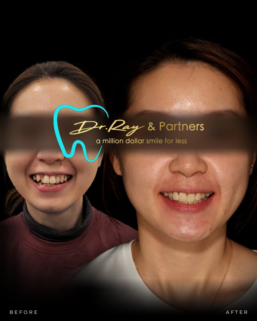 Braces patient smiling before and after treatment at Dr Ray & Partners Dental, eyes covered for privacy