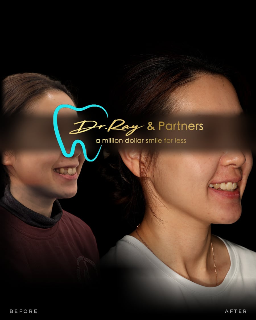 Braces patient smiling before and after treatment at Dr Ray & Partners Dental, eyes covered for privacy