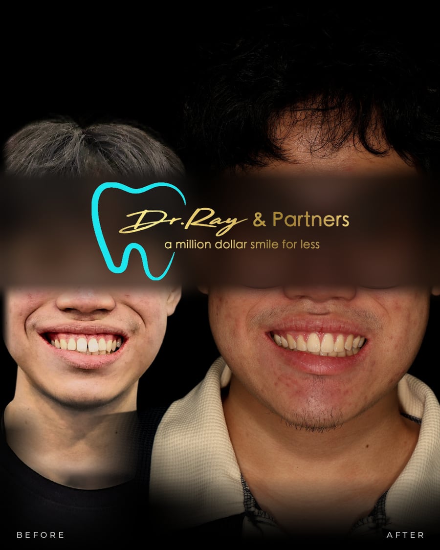Braces patient smiling before and after treatment at Dr Ray & Partners Dental, eyes covered for privacy