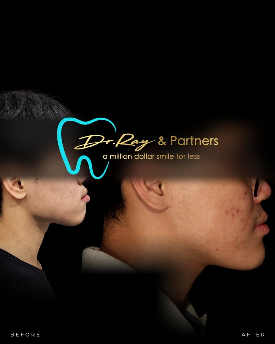 Braces patient smiling before and after treatment at Dr Ray & Partners Dental, eyes covered for privacy