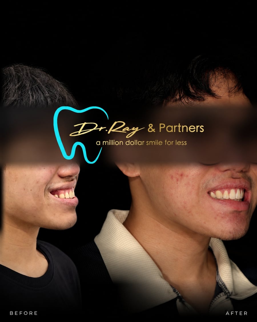 Braces patient smiling before and after treatment at Dr Ray & Partners Dental, eyes covered for privacy