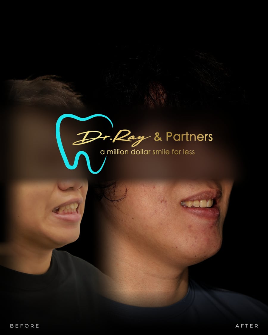 Braces patient smiling before and after treatment at Dr Ray & Partners Dental, eyes covered for privacy