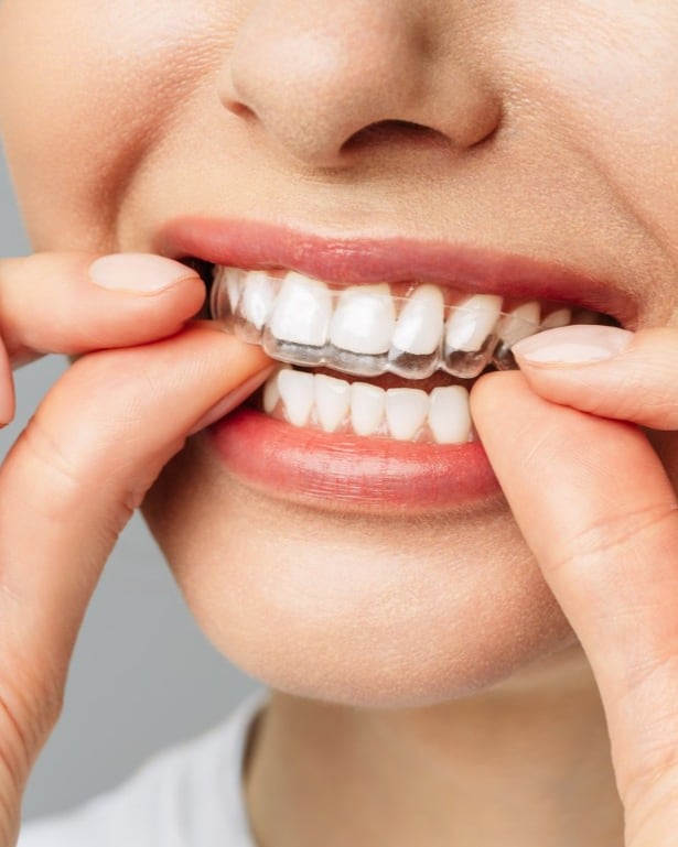 Clear Aligners