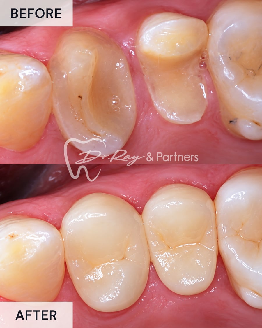 Before and after a crown restoring a broken-down back tooth at Dr Ray & Partners Dental