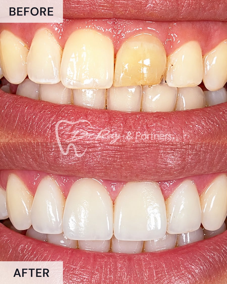 Before and after a crown on a discoloured upper front tooth at Dr Ray & Partners Dental