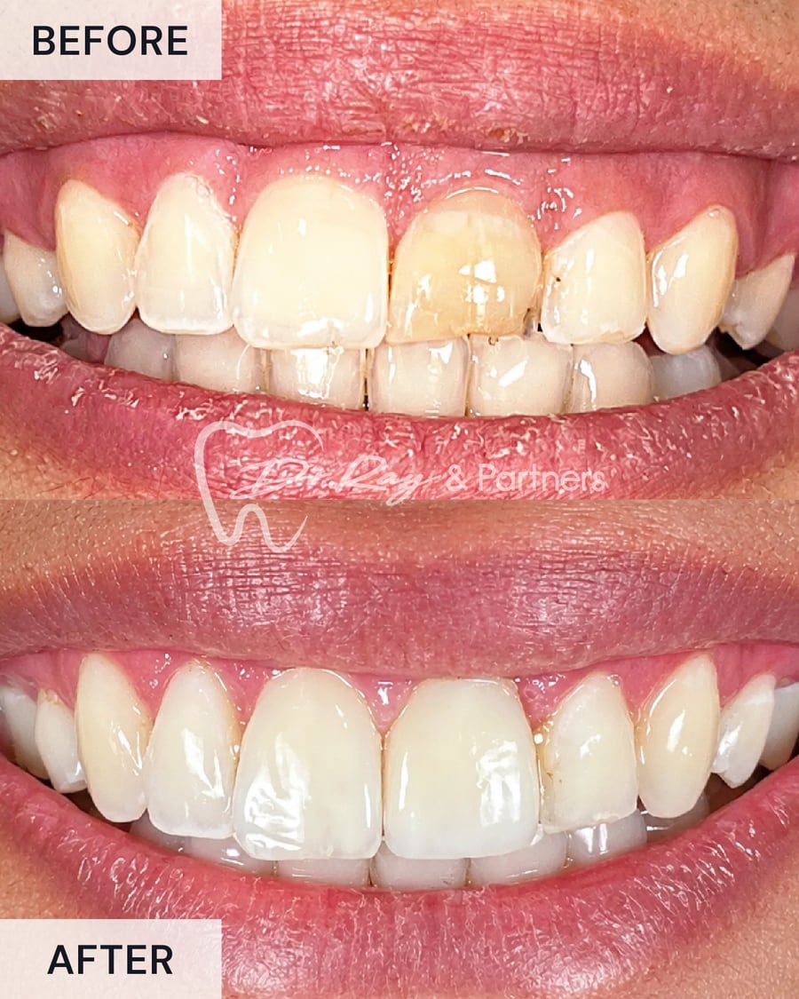 Before and after a crown on a discoloured upper front tooth at Dr Ray & Partners Dental