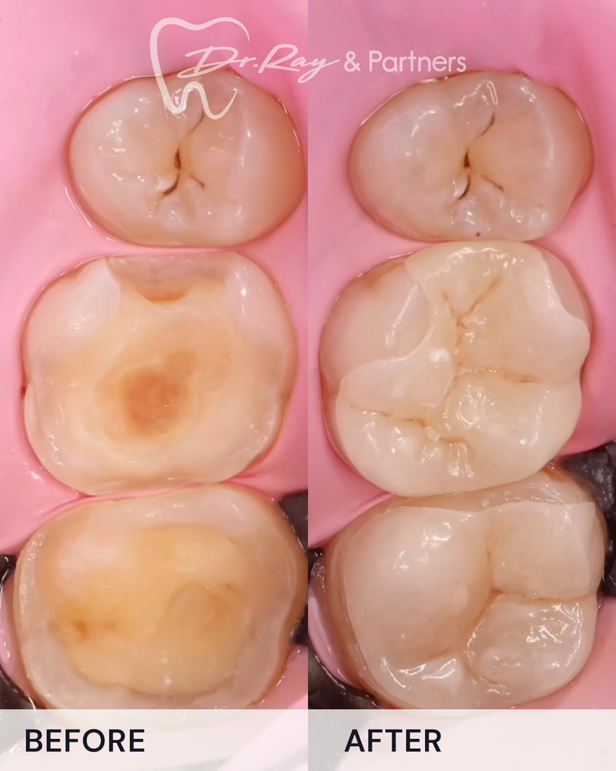 Before and after restoring decayed back teeth at Dr Ray & Partners Dental