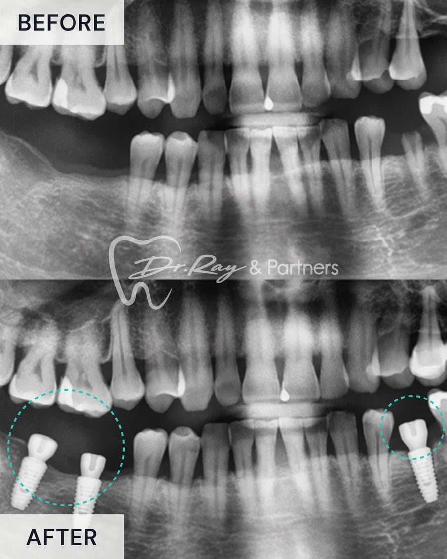 X-ray before and after two dental implants replacing missing lower back teeth at Dr Ray & Partners Dental