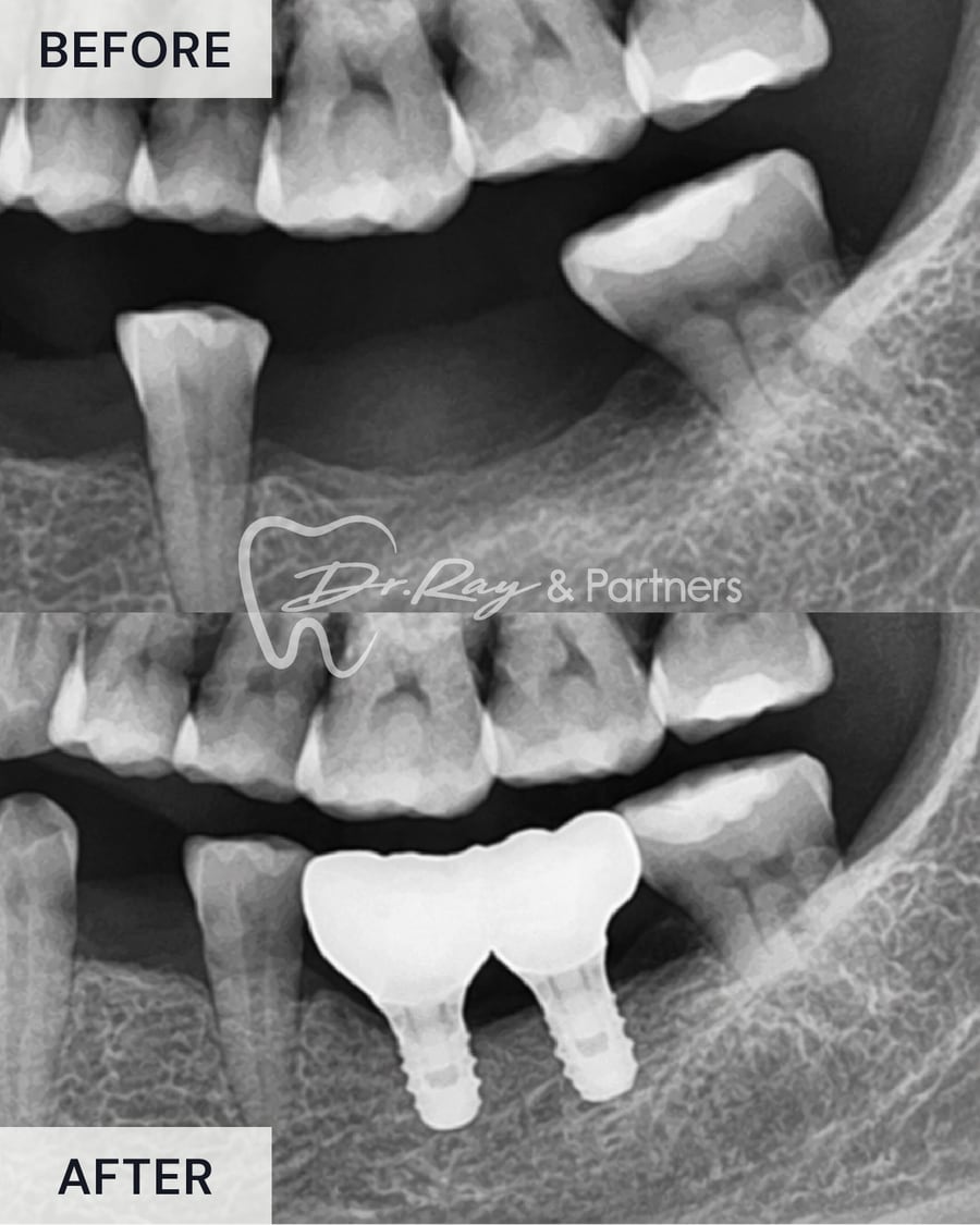 X-ray before and after an implant-supported bridge replacing missing lower back teeth at Dr Ray & Partners Dental