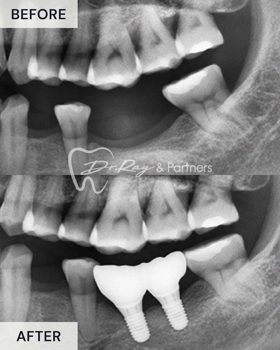X-ray before and after an implant-supported bridge replacing missing lower back teeth at Dr Ray & Partners Dental