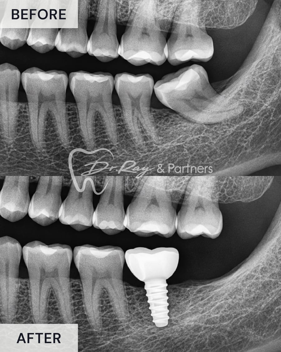 X-ray before and after a single dental implant replacing a missing lower molar at Dr Ray & Partners Dental