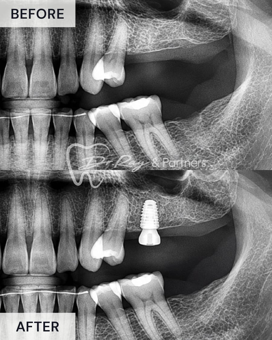 X-ray before and after a single dental implant filling a gap in the back teeth at Dr Ray & Partners Dental