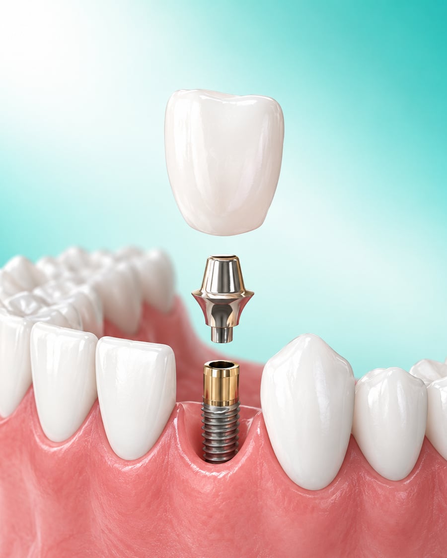 Illustration of an implant post, abutment and crown being fitted at Dr Ray & Partners Dental