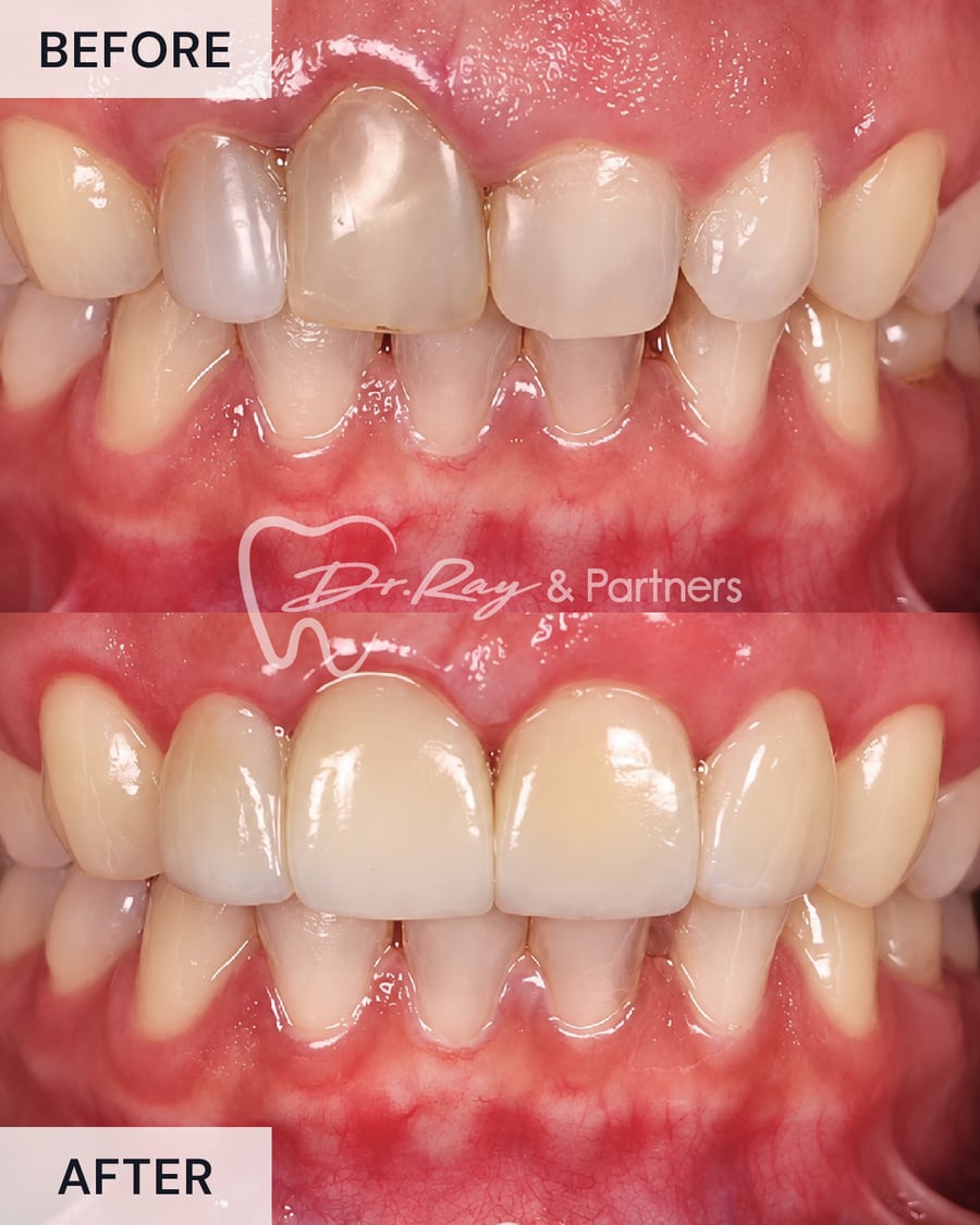 Before and after: an uneven gum line evened out and front teeth restored at Dr Ray & Partners Dental