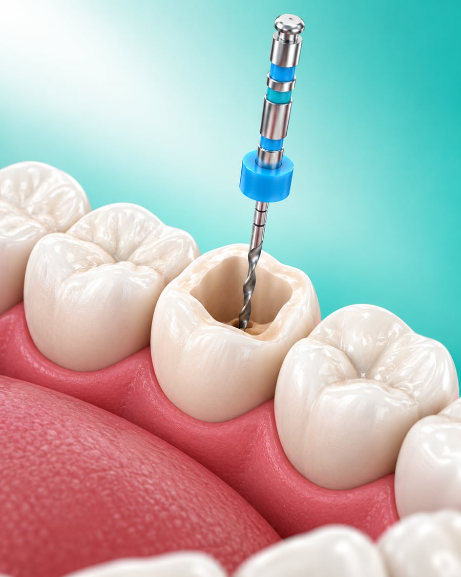 Root Canal Treatment