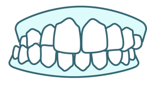 Illustration of crossbite, a teeth alignment issue Angel Aligner can treat