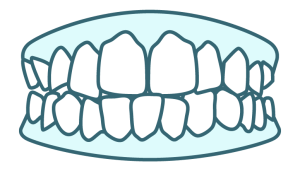Illustration of crowding, a teeth alignment issue clear aligners can treat