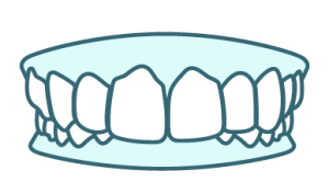 Illustration of deep bite, a teeth alignment issue Angel Aligner can treat