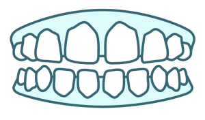 Illustration of spacing, a teeth alignment issue Angel Aligner can treat