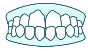 Illustration of underbite, a teeth alignment issue Angel Aligner can treat