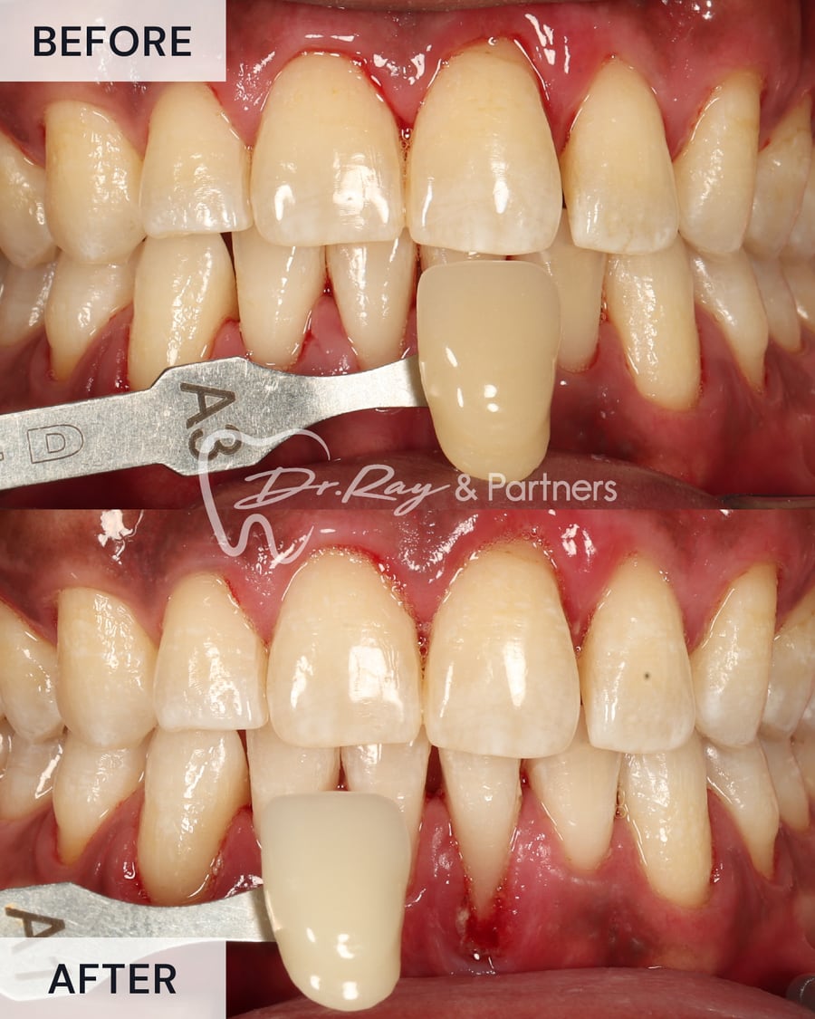 Before and after teeth whitening, compared against a shade guide at Dr Ray & Partners Dental, case 1