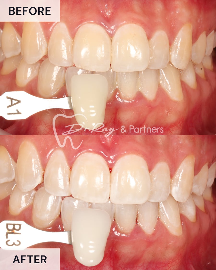 Before and after teeth whitening, compared against a shade guide at Dr Ray & Partners Dental, case 2