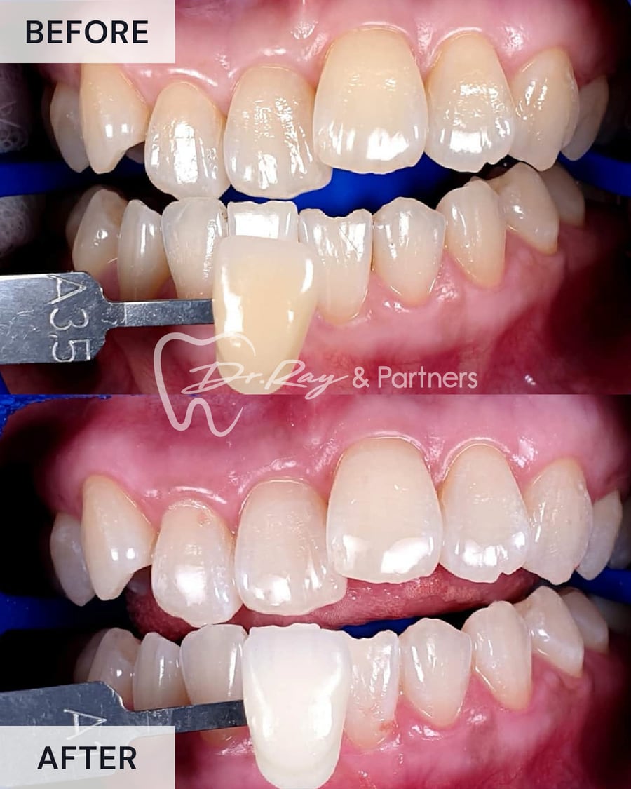 Before and after teeth whitening, compared against a shade guide at Dr Ray & Partners Dental, case 2