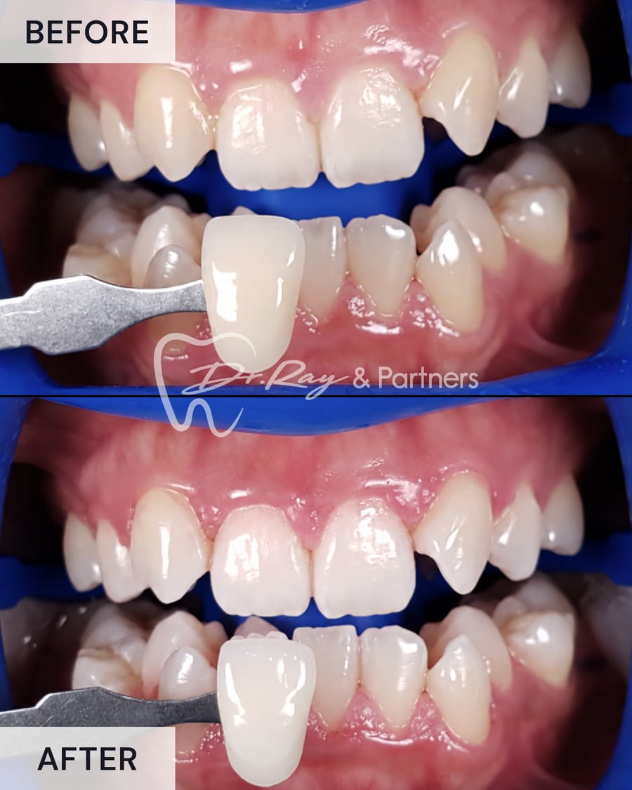 Before and after teeth whitening, compared against a shade guide at Dr Ray & Partners Dental, case 3