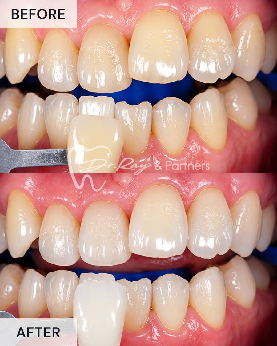 Before and after teeth whitening, compared against a shade guide at Dr Ray & Partners Dental, case 4