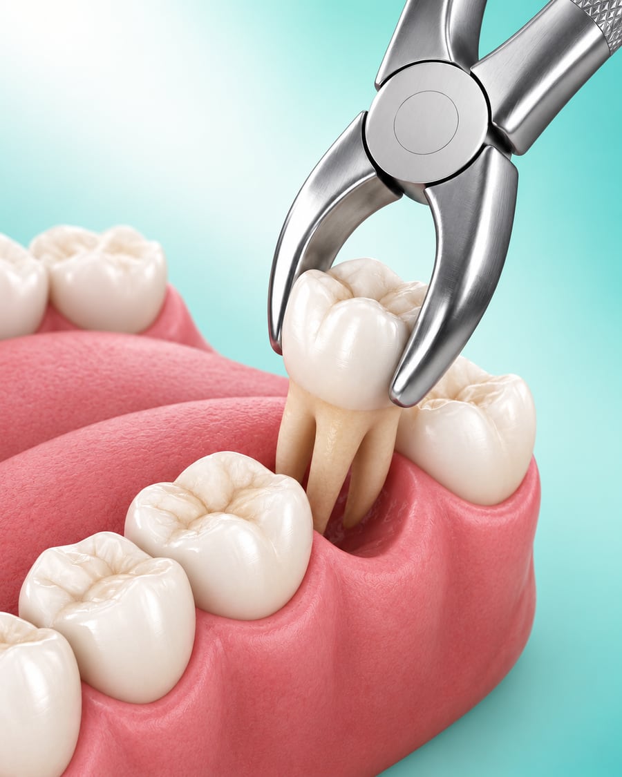 Tooth Extraction