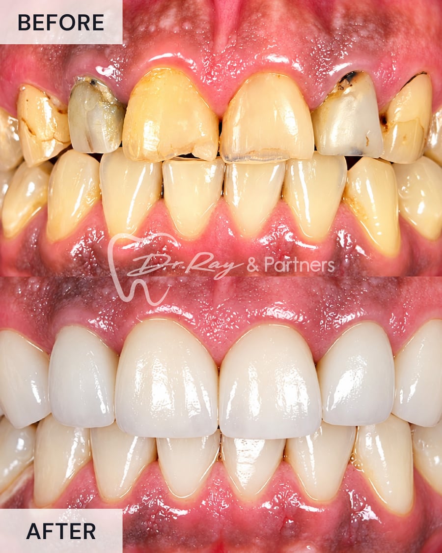Before and after veneers on worn, discoloured upper front teeth at Dr Ray & Partners Dental