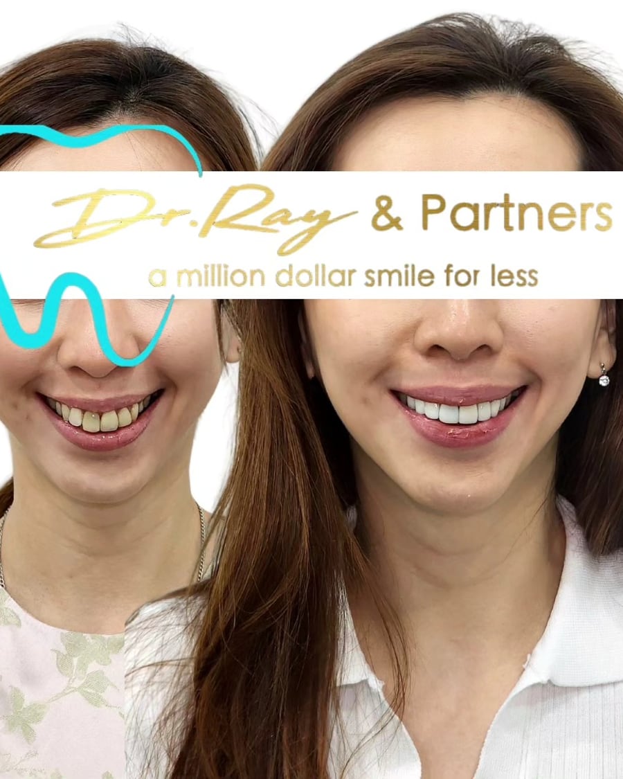 Patient smiling before (left) and after (right) veneers, uneven yellowed front teeth made bright and even at Dr Ray & Partners Dental