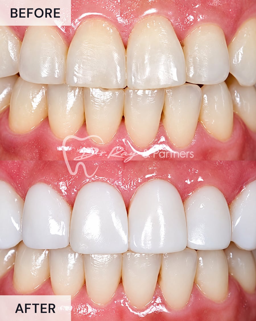 Before and after veneers brightening and evening out the upper front teeth at Dr Ray & Partners Dental