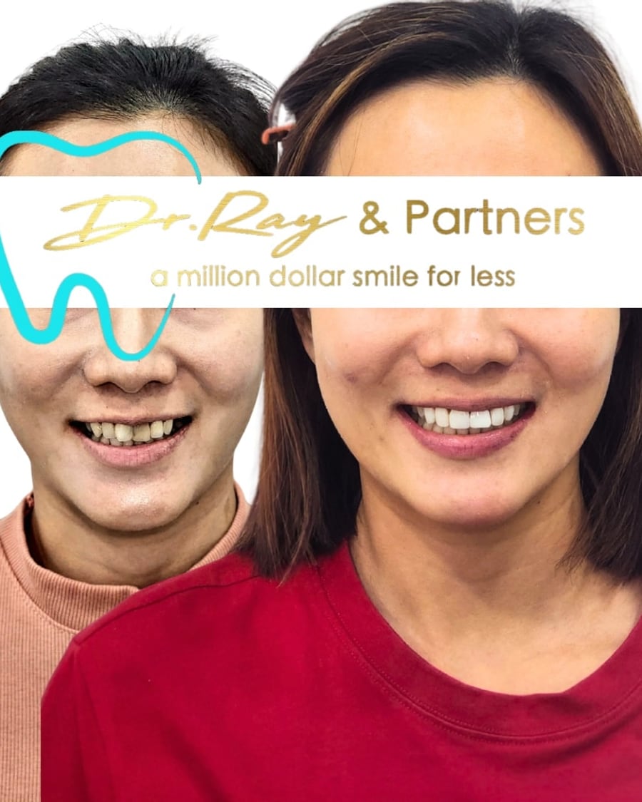 Patient smiling before (left) and after (right) veneers, discoloured crooked front teeth made bright and straight at Dr Ray & Partners Dental