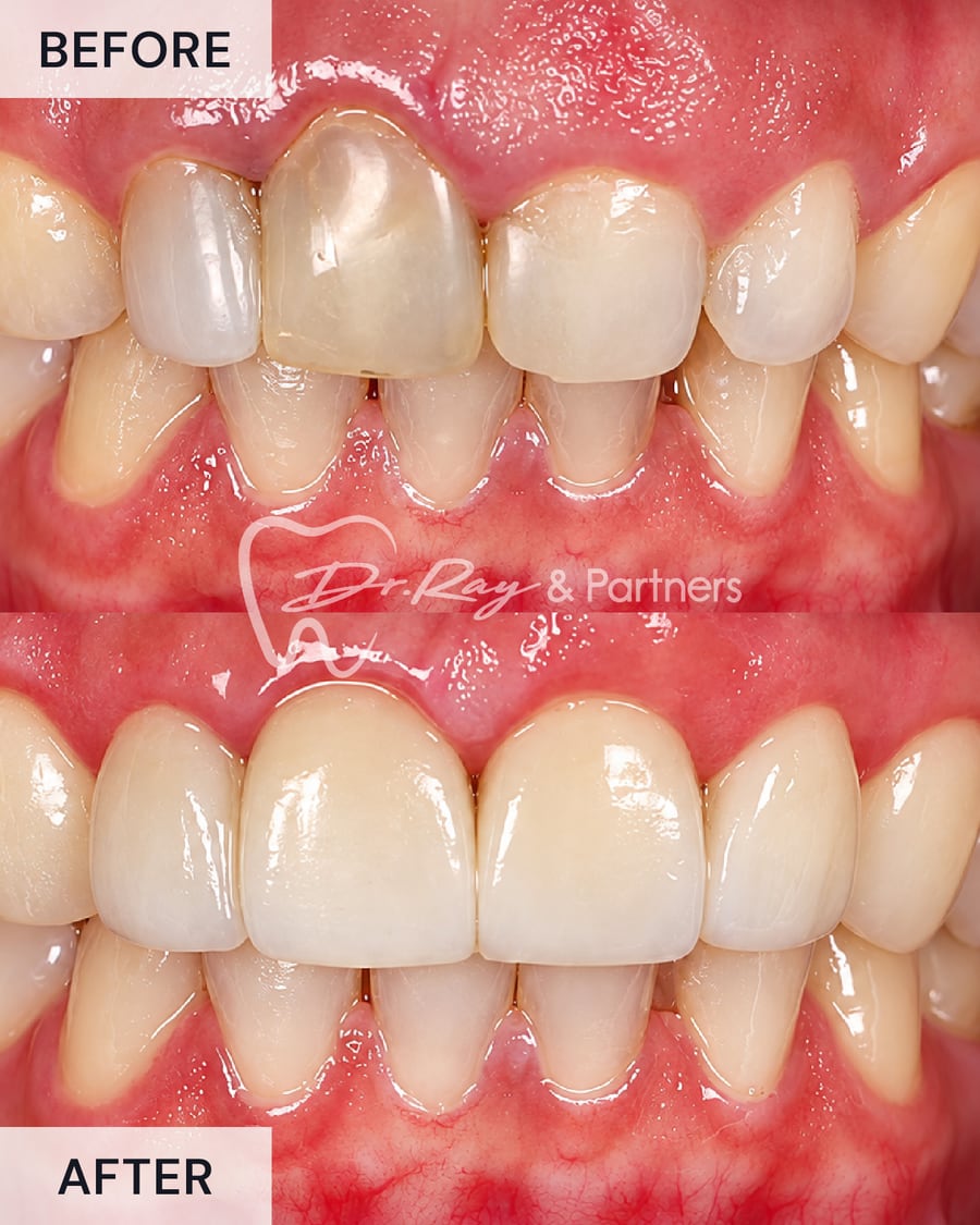 Before and after veneers covering a darkened upper front tooth at Dr Ray & Partners Dental