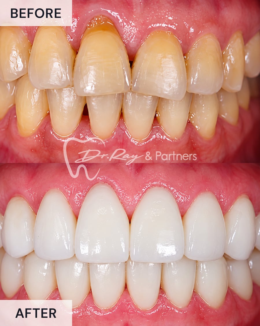 Before and after veneers covering stained edges on the upper front teeth at Dr Ray & Partners Dental